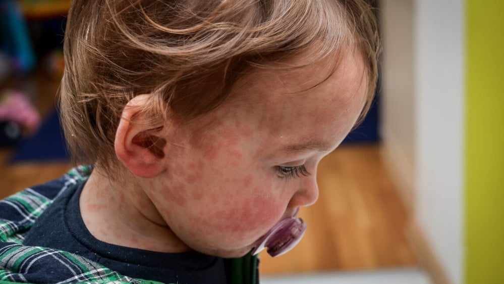 Measles outbreak due to declining vaccination rates