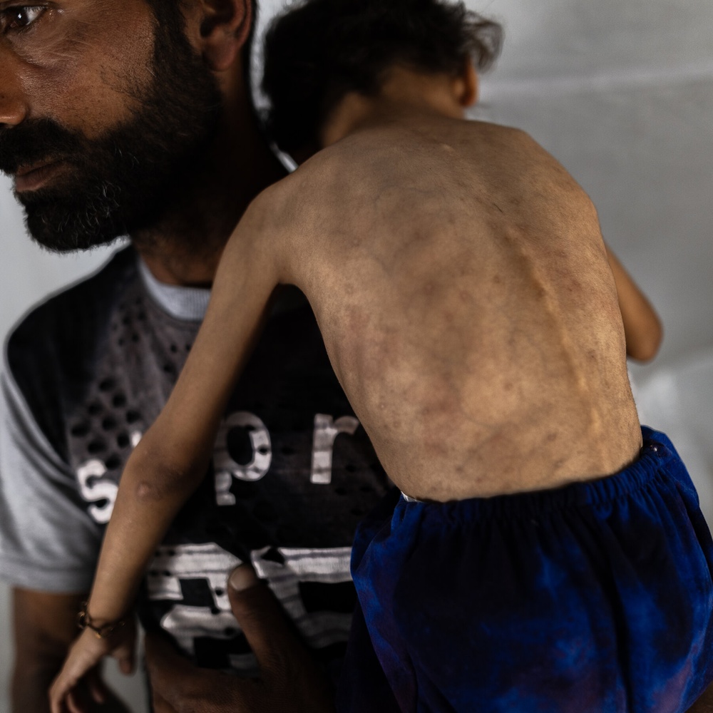 In Gaza's Emaciated Children, a Hunger Crisis Is Laid Bare
