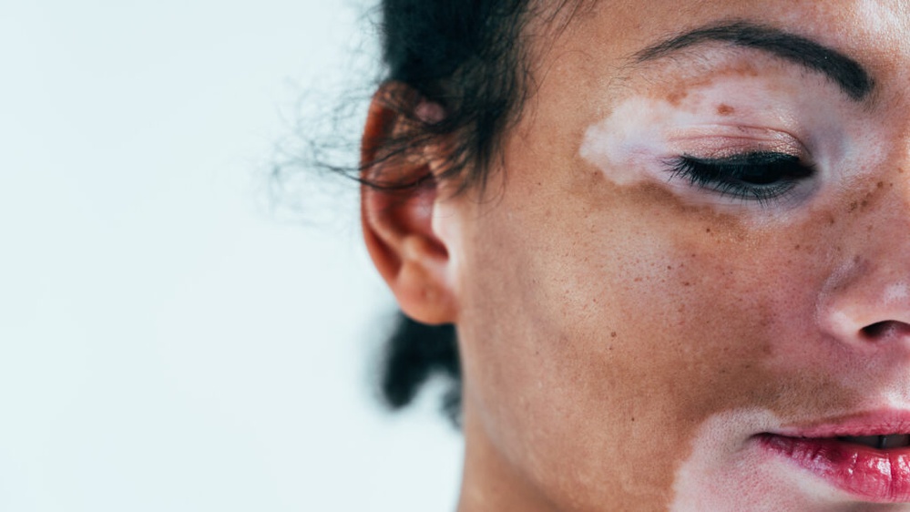 FDA approves first at-home therapy for skin repigmentation in vitiligo patients