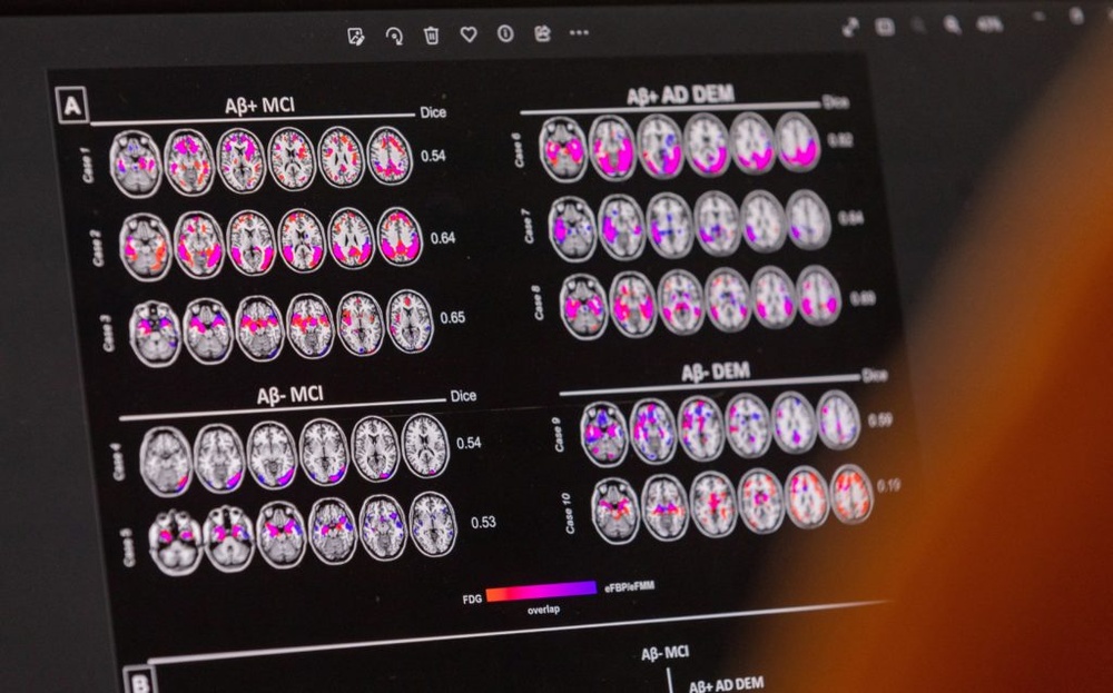 Blood tests for Alzheimer's may be coming to your doctor's office. Here are 4 things to know