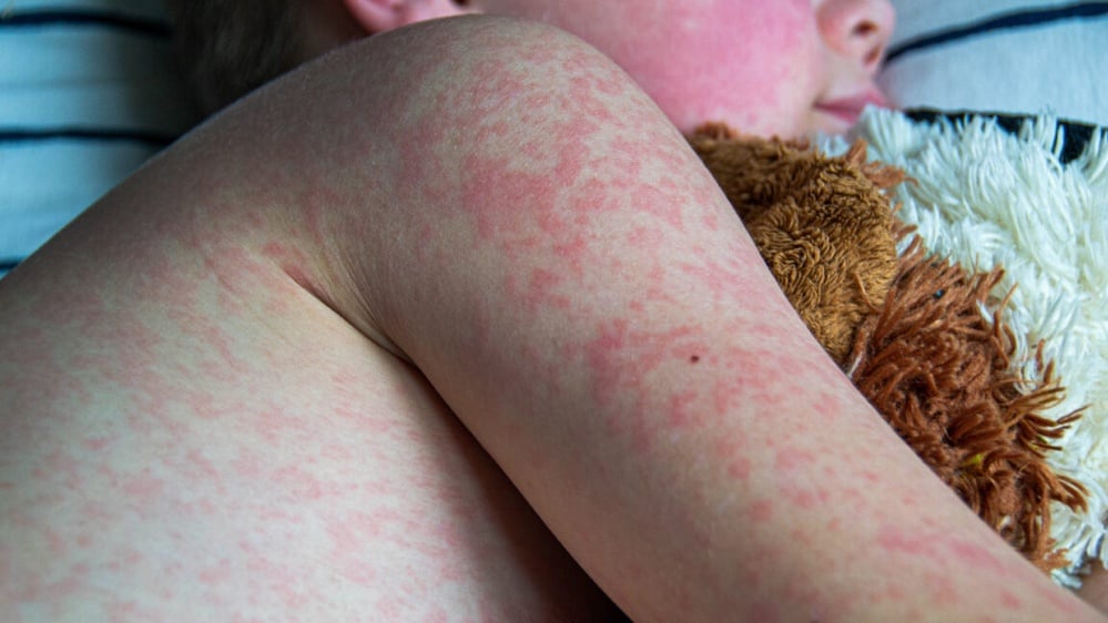 Measles outbreak in Texas exacerbated by low vaccination rates and public health challenges.