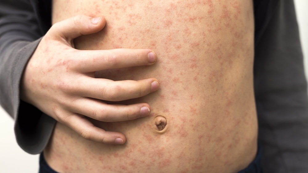 'We're already on the precipice of disaster': Deadly measles outbreaks could explode across the US in the next 25 years if vaccinations fall, model predicts