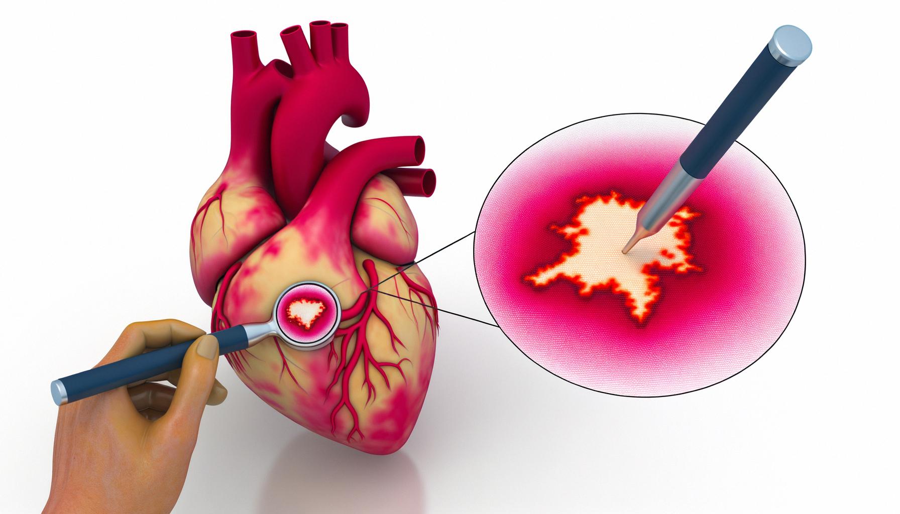 Cardiac fibrosis mapping offers new heart failure treatment pathways